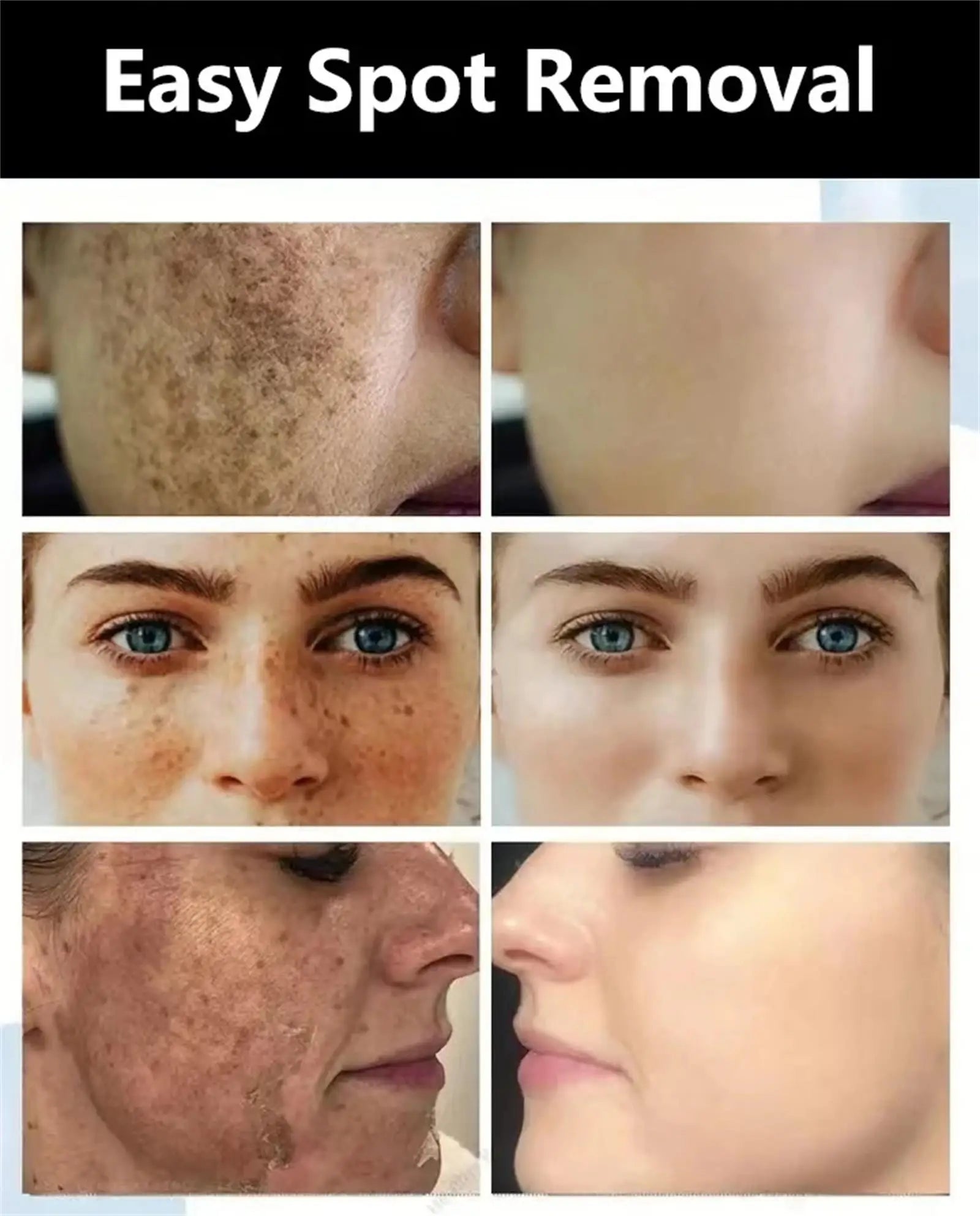 يقدم هذا السيروم المكثف تركيبة متطورة لاستهداف البقع الداكنة والنمش والميلانين، مما يساعد على توحيد لون البشرة وتقليل التصبغات بفعالية.
