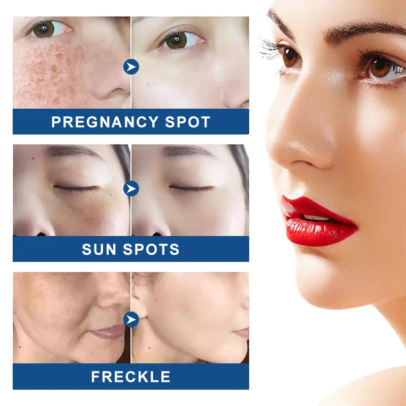 Dark Spots Remove Kojic Acid Cream Face Nicotinamide Effective Whiten Anti-pigmentation Improve Dullness Skin Care Cream 50ML