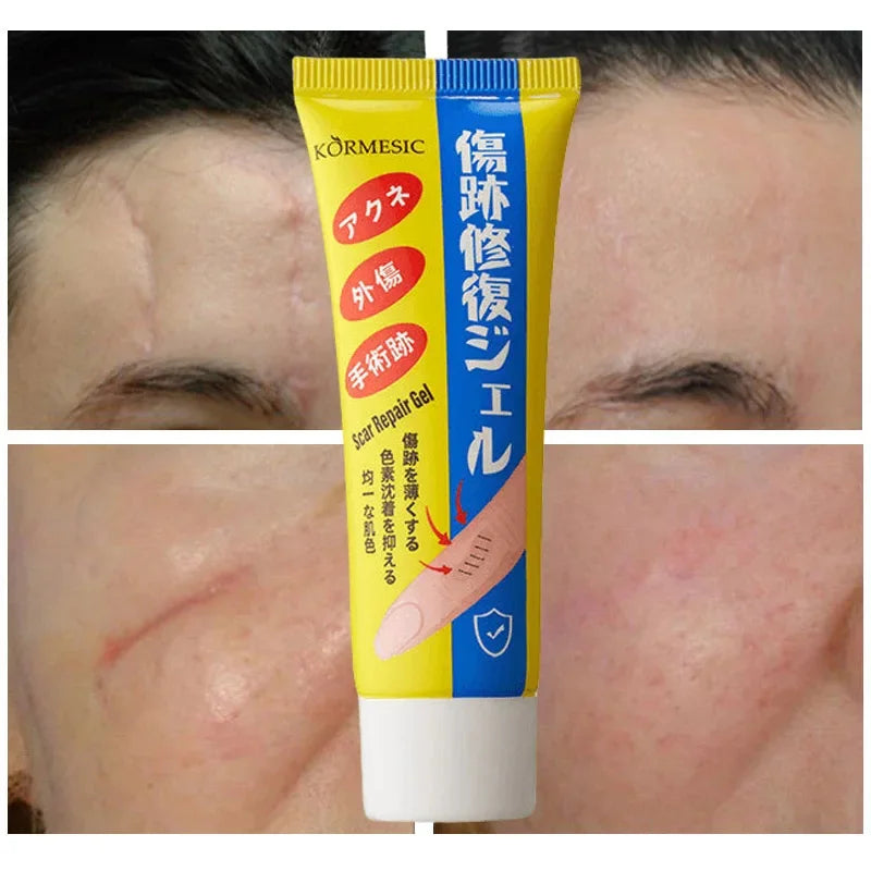 Fast Scar Removal Cream Treatment Stretch Marks Burn Surgical Scar Acne Spots Repair Gel Whitening Moisturizing Smooth Skin Care