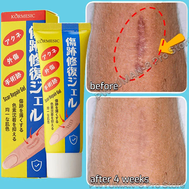 Fast Scar Removal Cream Treatment Stretch Marks Burn Surgical Scar Acne Spots Repair Gel Whitening Moisturizing Smooth Skin Care