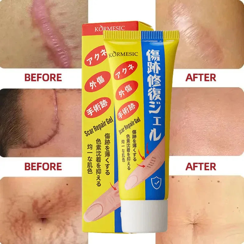 Fast Scar Removal Cream Treatment Stretch Marks Burn Surgical Scar Acne Spots Repair Gel Whitening Moisturizing Smooth Skin Care