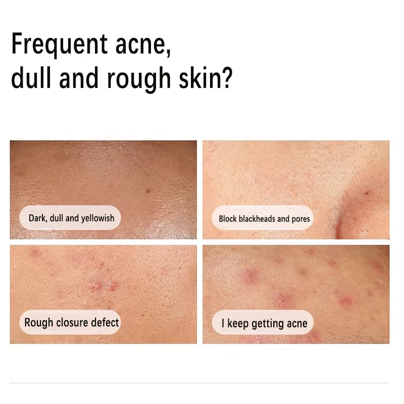 Hyaluronic Acid 2%+B5 Hydrating Serum Iacinamide 10%+Zinc 1% Serum 30ml AHA 30% + BHA 2% Peeling Solution 30ml Improve The Skin