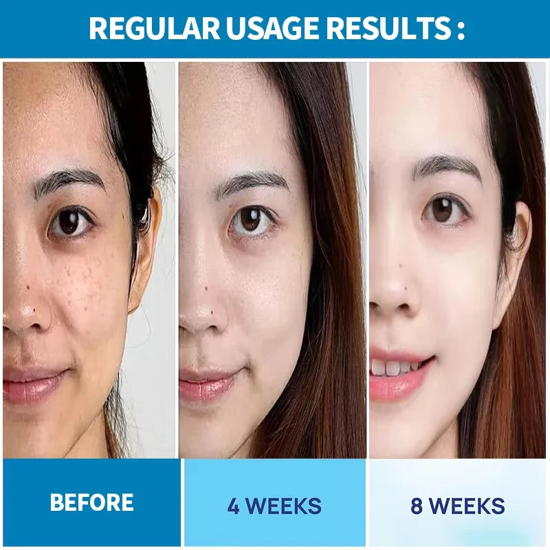 Dark Spots Remove Kojic Acid Cream Face Nicotinamide Effective Whiten Anti-pigmentation Improve Dullness Skin Care Cream 50ML